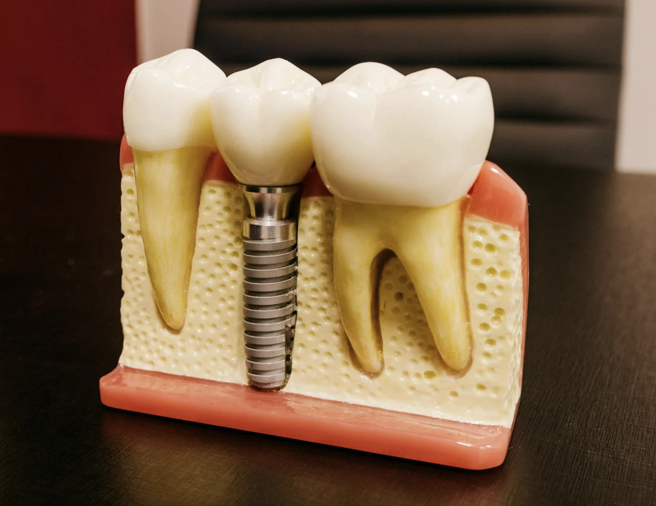 Dental Implants in Delmar, NY, 12054