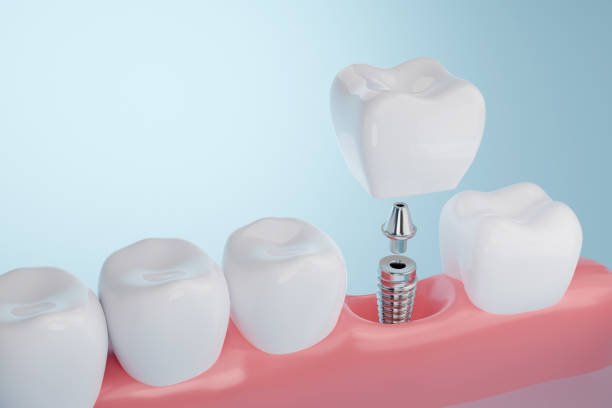Dental Implants Near Slingerlands, NY
